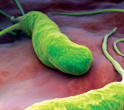 幽门螺旋杆菌感染有哪些症状：3大症状要注意