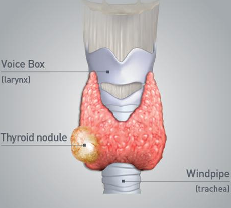 甲状腺结节怎么治疗最好：揉臂臑穴，治甲状腺结节