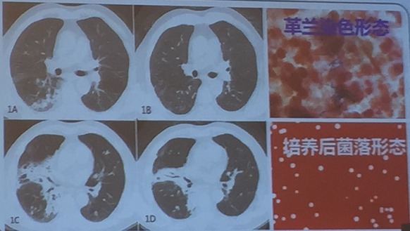 肺炎支原体感染人数明显下降_肺炎支原体抗体阳性是什么意思_支原体肺炎