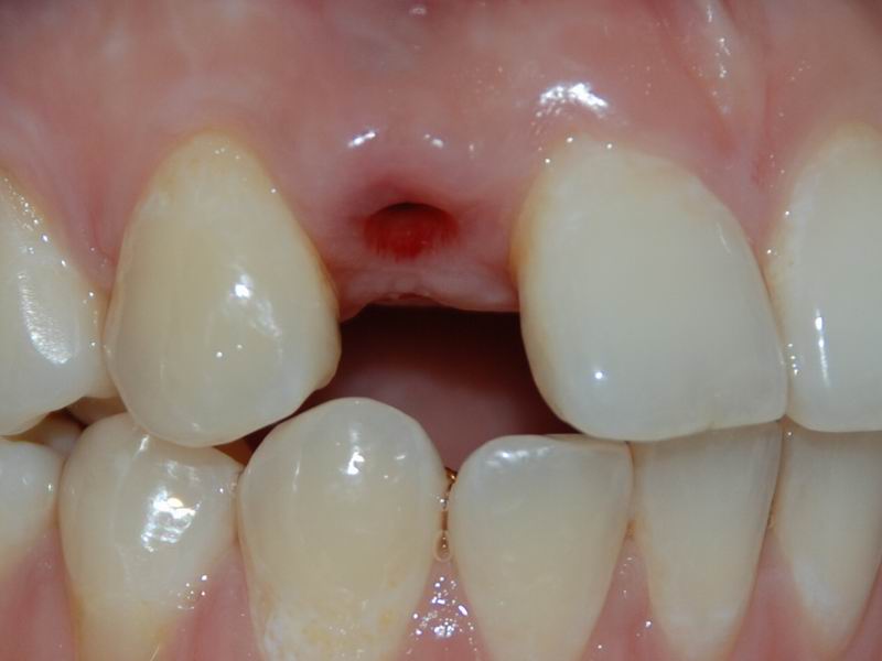 牙种植后多久可以正常吃饭_种植牙_牙种植体