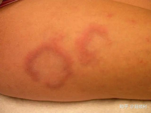 红斑狼疮_红斑狼疮图片和症状图片_红斑狼疮的寿命能活多大