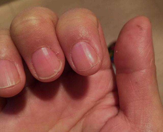 初期蜘蛛痣图片大全_早期蜘蛛_蜘蛛是前期还是后期